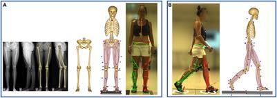 Subject-Specific Modeling of Femoral Torsion Influences the Prediction of Hip Loading During Gait in Asymptomatic Adults